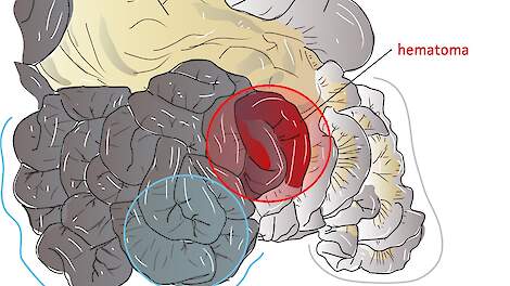 Een tekening van de dunne darm met een hematoom (rode gebied). Het kan tot een verstopping van de dunne darm leiden.